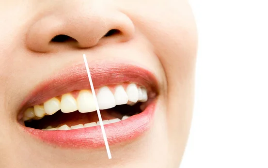 Teeth Whitening in Harrisburg | Your Complete Guide | Nova Dental